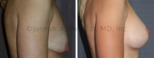 The main goal of Cosmetic Plastic Surgery is a pretty result. The Breast Augmentation Lift allows for control of both the size and the shape of the breasts. The cost is additional scar. In this case an Inverted-T scar was needed.