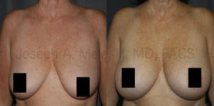 Breast Augmentation with Breast Lift was used to enlarge the breasts, elevate the nipple and tighten the breast skin, especially the skin that hangs at the bottom of the breasts. The technique used, a horizontal breast lift, does not require the vertical scar seen in the anchor or inverted-T type breast lifts.