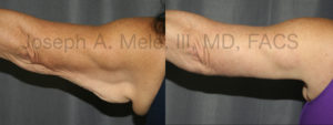 The above Arm Lift before and after pictures demonstrate how careful scar placement improves results. In this case, the excess skin was removed using a scar that runs from the inside of the elbow to the back of the armpit. Even with the elbow rotated back, the scar is still hidden along the lower border of the arm.