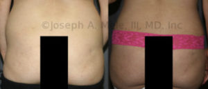 The Brazilian Buttocks Lifts is again the fastest growing cosmetic plastic surgery procedure.