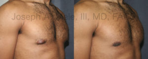 Gynecomastia may involve just the area beneath the nipple and areolae or the entire chest. In the male breast reduction before and after pictures above the fullness beneath the nipples was removed through a small incision placed along the lower margin of the areolae.