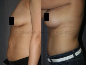 The most common Mommy Makeover combination is the one depicted above: Breast Augmentation and a Tummy Tuck. Breast Implants restore lost breast volume, while the Tummy Tuck flattens and tightens the abdominal wall.