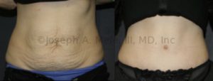 After pregnancy, or weight loss, the abdominal muscles, skin and fat can all be compromised. Fortunately, the Tummy Tuck can repair all three areas. Be certain to find a Board Certified Plastic Surgeon with experience for your belly rejuvenation.