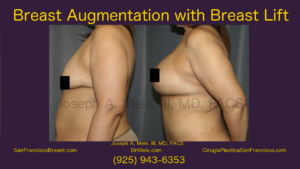 Breast Augmentation Lift Video with Mastopexy Augmentation Before and After Pictures