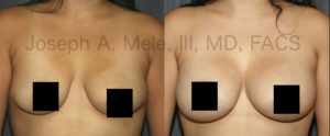 Breast Augmentation adds volume, while Breast Lifts reshape. What happens when you put them together? You get Cosmetic Plastic Surgery that can enhance both breast volume and shape.