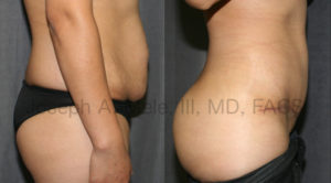 A Brazilian Butt Lift was added to this Mommy Makeover. Excess fat from the belly and muffin top was removed and transplanted into the buttocks, to enhance both the size and shape of the buttocks.