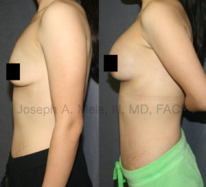 The Mommy Makeover is the most popular, and one of the most satisfying combination cosmetic plastic surgery procedures. With the ability to reshape the breast and flatten the belly, the Mommy Makeover is the procedure of choice the rejuvenate the female form after pregnancy or weight loss.