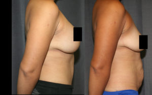 The Mommy Makeover combines the most common body shaping procedures into a single operation for breast and belly shaping.