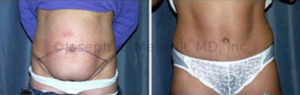 The above Tummy Tuck before and after pictures show where the skin is removed.