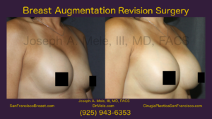 Breast Implant Revision Video Presentation with Before and After Pictures