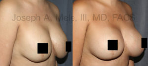 The most common reason for Breast Augmentation Revisions is to go bigger. This is especially common after pregnancy with preexisting breast implants as shown above.