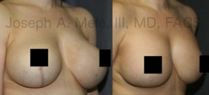 The above Breast Augmentation Revision pictures demonstrate the correction of bottoming out.