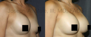 Breast Implant Deflation is one reason for Breast Augmentation Revision Surgery.