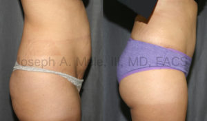 The Above Tummy Tuck before and after pictures show an example what the combination of Tummy Tuck, Liposuction and Brazilian Buttock Lift can do. In the post operative picture on the right, the abdomen is flatter, the muffin top is missing and the buttocks are fuller and rounder.