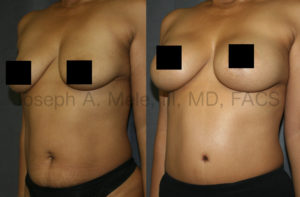 Mommy Makeovers are a class of cosmetic plastic surgery procedures that enhance both the breasts and the belly. The Mommy Makeover before and after pictures above are an example of what can be accomplished with the combination of Breast Augmentation Lift and Tummy Tuck. As with all plastic surgery, careful patient selection is very important.