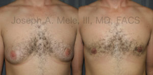 The above Gynecomastia reduction surgery photos show what is possible with a combination of liposuction and direct excision for an enlarged male chest.