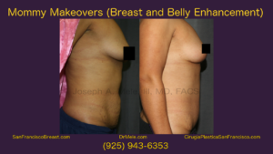 Mommy Makeover Video featuring Breast Augmentation and Tummy Tuck Before and After Pictures