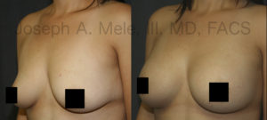 Breast Implants can enlarge and enhance the shape of a woman's breasts.