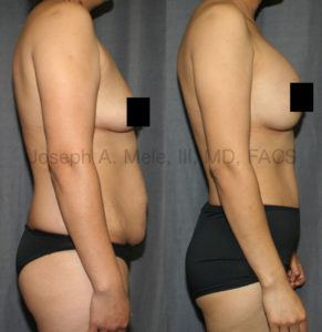 This mommy has been shown here before. She is maintaining her healthy lifestyle and her beautiful results.