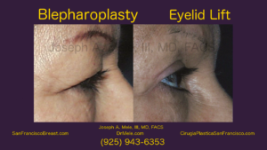 Blepharoplasty Video with Eyelid Lifts Before and After Photos