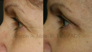 In these Blepharoplasty Before and After Pictures, the before picture on the left shows the lateral brow skin completely covering the outer eyelid. In the after picture on the right the brow skin is elevated, giving a much cleaner, refreshed and younger look. When the brow itself sags, a Brow Lift may be recommended.