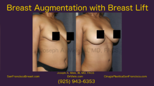 Breast Augmentation and Breast Lifts Viideo with Before and After Photos