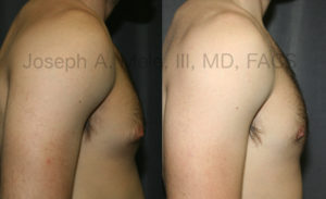 Male Breast Reduction is one of the most requested cosmetic plastic surgery procedures year after year.