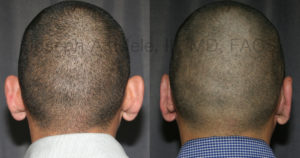 Short hair provides no disguise for prominent ears. Since the incisions are hidden ini the fold behind the ears, short har is not a problem for concealing the Otoplasty.