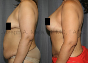 Massive weight loss will shrink our volume, but does not reliably shrink our skin. In the before and after pictures above, breast volume is restored with breast implants. Sagging breast skin is tightened with a breast lift. Excess abdominal skin is removed, and the belly bulge caused by stretched out abdominal muscles is flattened by preparing the muscle sheath.