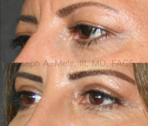 Upper and Lower Blepharoplasty Before and After Pictures: Sagging upper eyelid, caused by excess upper eyelid skin, cause a tired and disinterested appearance. Bags under the eyes make use look tired. Blepharoplasty can open your eyes to a more youthful, bright and alert appearance.