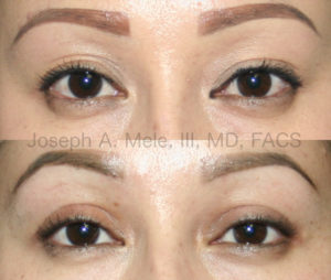 Asian Eyelid Double Eyelid Surgery can correct low, indistinct or multiple eyelid folds. These double eyelid before and after pictures show how the folds can be raised, sharpened and made more symmetrical.