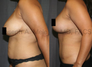 Another Mommy Makeover before and after. Again Abdominoplasty is combined with Breast Enhancement. In this case a Breast Lift was combined with the Tummy Tuck for a uplifted, aesthetic result.