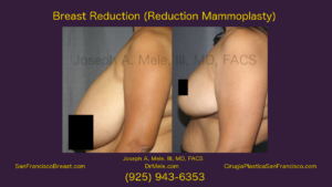 Breast Reduction Video with Reduction Mammoplasty Before and After Pictures