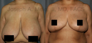 Reduction Mammoplasty Before and After Pictures: Breast Reduction not only helps reduce the symptoms associated with large breasts but can also increase ones fashion options.