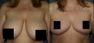 Breast Reduction combines reduction of the breast volume with a lift to reduce the torque on the back and the neck.