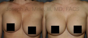 Capsular Contracture is tightening of the scar pocket that holds the breast implant in place. In the left before-photo, Capsular Contracture elevated this patient's right breast implant and caused severe asymmetry. The right after-photo shows correction after capsule surgery and breast implant revision surgery. Now, Capsular Contracture is covered by all three US FDA approved manufacturers' warranties.