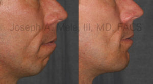 Chin Implants provide Chin Augmentation by increasing the the chin's projection and providing enhanced facial harmony.