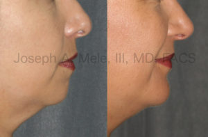 Chin Augmentation before and after pictures: Chin Implants can increase chin projection and definition. Before Chin Augmentation, her chin appears flat, is poorly defined and allows the lip ad neck to blend into each other. After Chin Augmentation, the Chin Implant provides a defined chin, which clearly separates the lip from the neck. Additionally, the chin's projection now matches the lips' and balances the lower face.