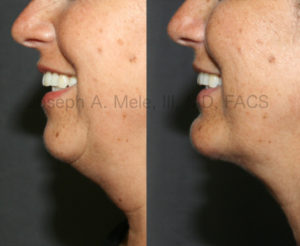 Chin Implants provide stable Chin Augmentation. In the above Chin Implant before and after pictures the patient is smiling. Even with animation, the enhanced projection is maintained and the definition of the neck line is clearly defined. In case when there is disproportionate fat of the neck, Chin Augmentation can be combined with Neck Liposuction to further enhance your profile.