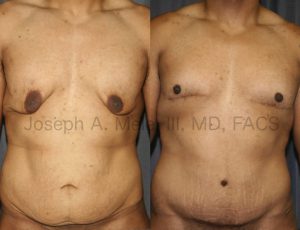 Massive Male Breast Reduction
