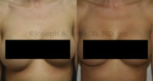 Seromas are collections of fluid. This normally occurs around the breast implant for the first few days after surgery and resolves spontaneously. Seromas that appear years after surgery should be investigated, and breast implant warranties are starting to include this testing and treatment, too