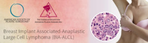 ASPS and ASAPS summary of BIA-ALCL in 2019