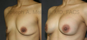 The Breast Augmentation before and after photos above show how Breast Implants alone add back the volume lost with pregnancy and breast feeding. A breast lift, in this case a Periareolar Breast Lift, could have been used to reduce the areolae or bring the nipples a little higher on the chest, but the result is good, and there is no additional scarring around the nipple.