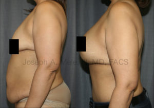 The above Mommy Makeover before and after photos show the results of Breast Augmentation, Breast Lift and Tummy Tuck.