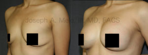 The Mastopexy Augmentation shown above was for nipple location rather than sagging skin. The Breast Implants add back the volume lost with pregnancy and breat feeding. The breast lift, in this case a Periareolar Breast Lift, was used to bring the nipples up to the front of the breasts.