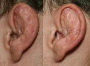 This cauliflower ear is thick. The hematoma has filled the ear up to the rim of the helix. Plastic surgery was performed to remove the dense scar tissue, and restore the normal topography of the external ear.