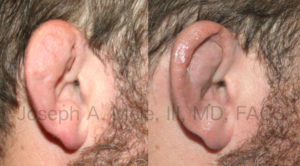 Cauliflower ear is caused by trauma. Like most medical problems, prevention or early intervention are preferable. Late treatment, as shown in the Cauliflower Ear Before and After Pictured above, can help; however, creating a beautiful ear is very difficult.