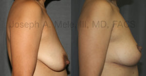 It is easier to see the details of Breast Augmentation with a Breast Lift in these uncensored before and after photos. The breast is larger, thanks to Breast Augmentation, and the nipple is higher thanks to the inverted-T beast lift. The areolae were also reduced with an Areolar Reduction.