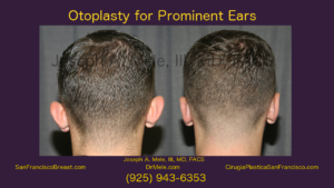 Cosmetic Ear Surgery (Otoplasty) Video with Ear Pinning Before and After Pictures