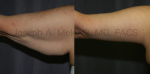 Brachioplasty removes excess skin and creates a tighter, smaller upper arm.